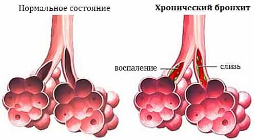 Остаточные явления после бронхита