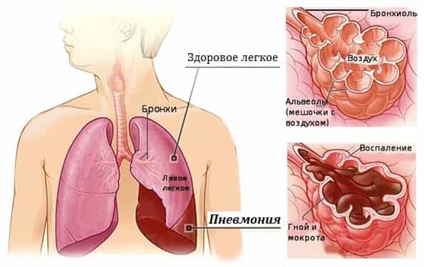 Пневмония