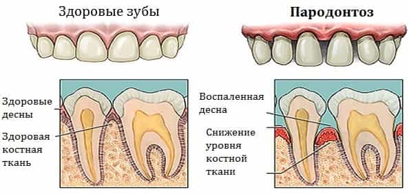 Пародонтоз