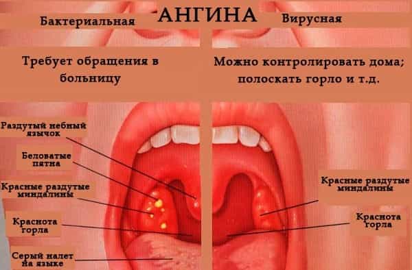 Симптомы ангины