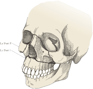 Переломы верхней челюсти