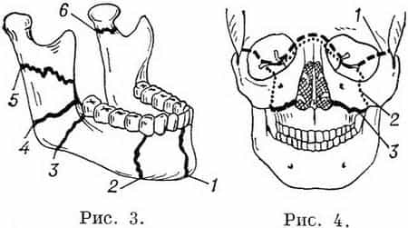 Перелом нижней челюсти