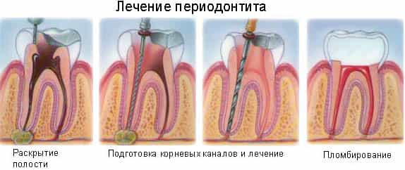 Периодонтит