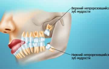 Прорезывание затрудненное зуба 