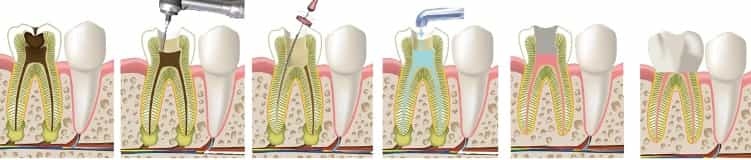 Лечение пульпита