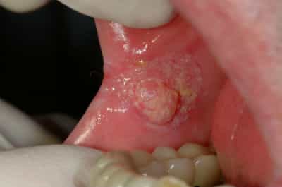 Рак слизистой оболочки полости рта.