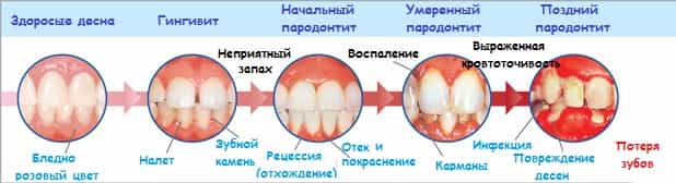 Пародонтит