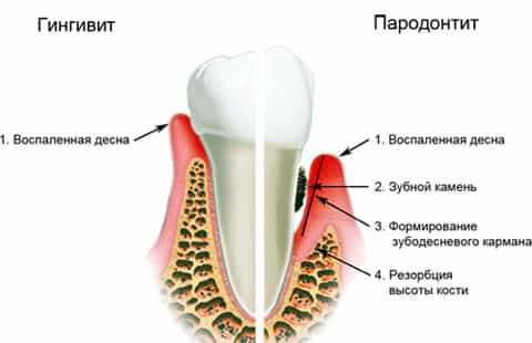 Пародонтит