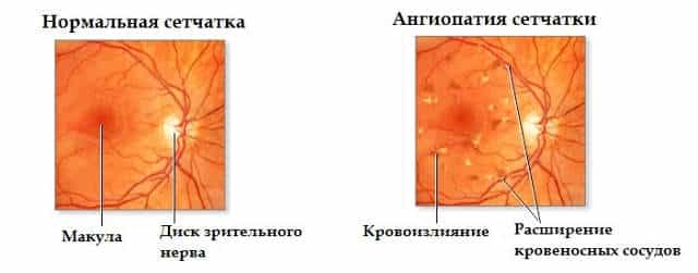 Гипертопическая ангиопатия