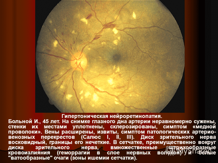 Гипертоническая нейроретинопатия