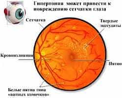 Гипертоническая ретинопатия