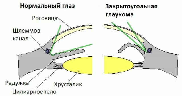 Глаукома