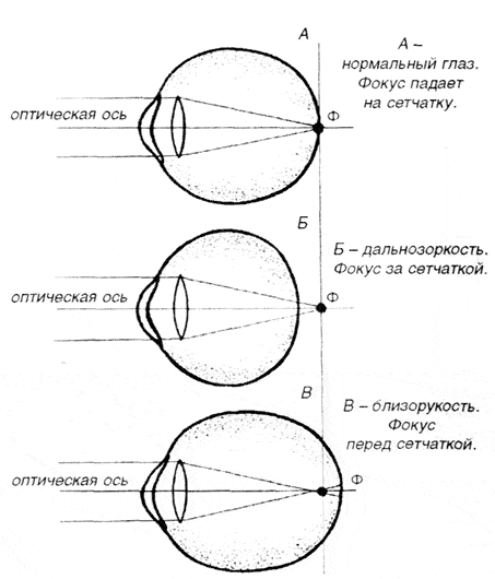 Дальнозоркость