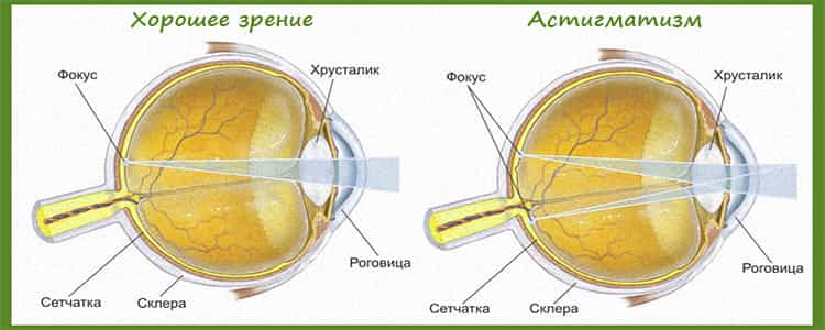 Астигматизм