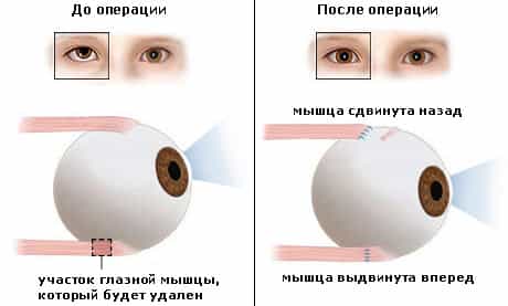 операция по исправлению косоглазия