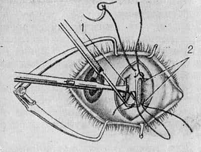 операция по исправлению косоглазия