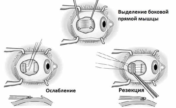 операция по исправлению косоглазия