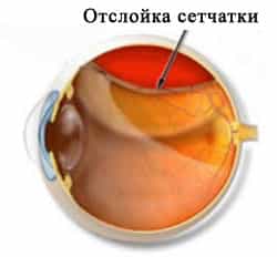 Отслоение сетчатки при астигматизме