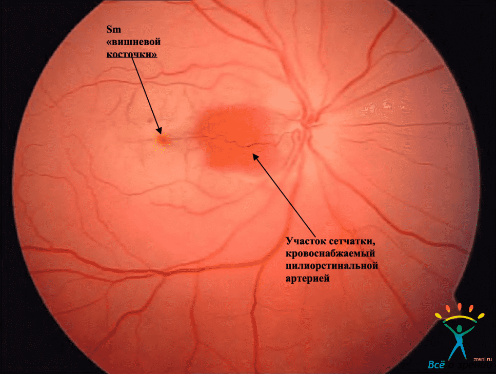 Непроходимость сосудов сетчатки острая