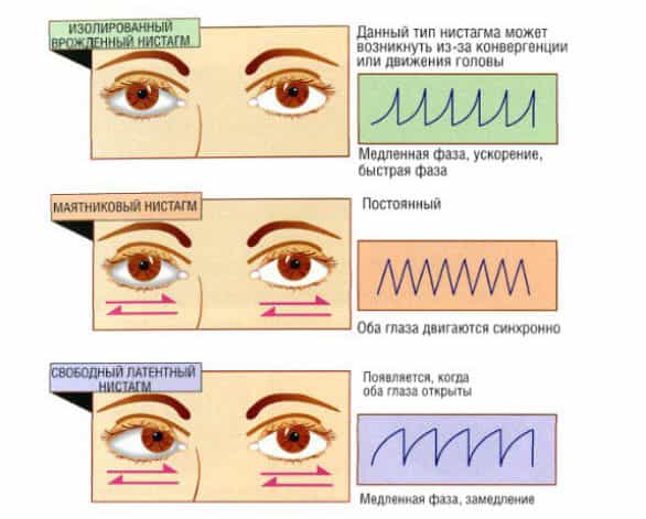 Нистагм