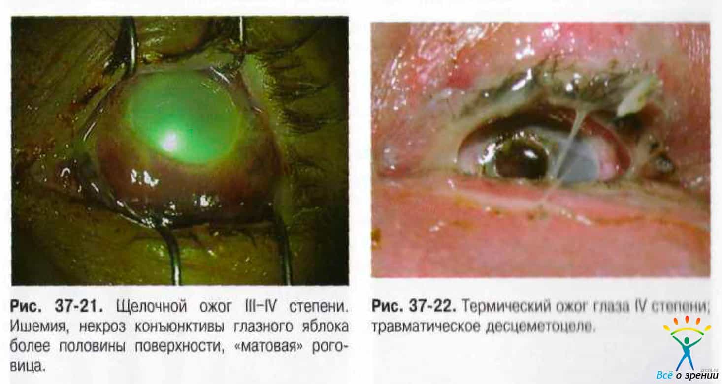 Термический и щелочной ожоги глаз