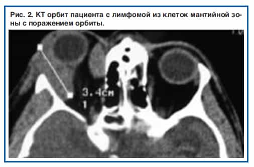 Опухоли орбиты (глазницы)