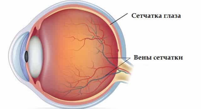 Ретинит (воспаление сетчатки)