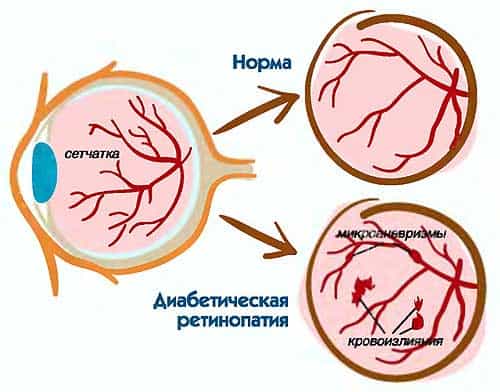 Ретинопатия диабетическая