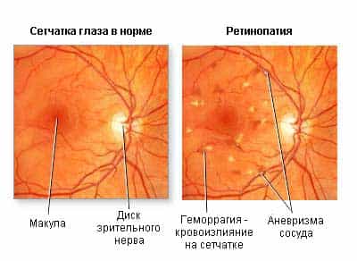 Ретинопатия диабетическая