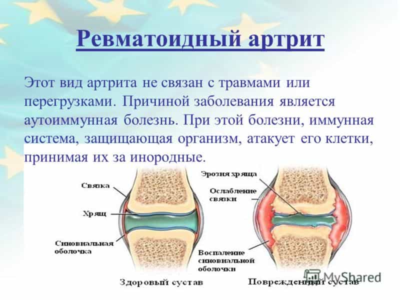 Артрит ревматоидный