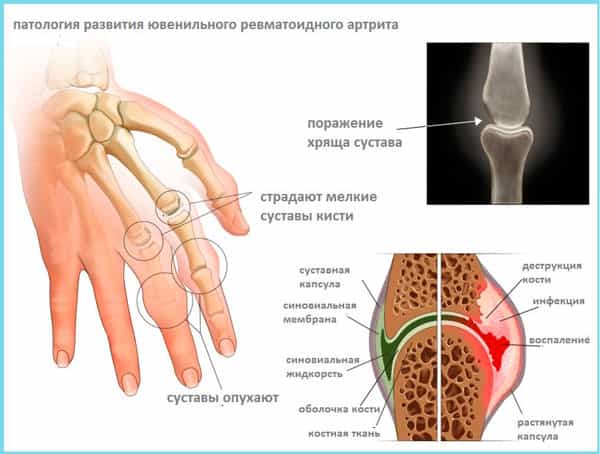 Ревматоидный артрит кисти