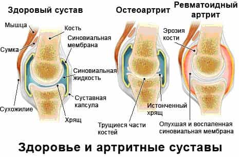Артрит ревматоидный коленного сустава