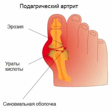 Артрит подагрический