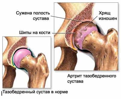 Артрит тазобедренного сустава