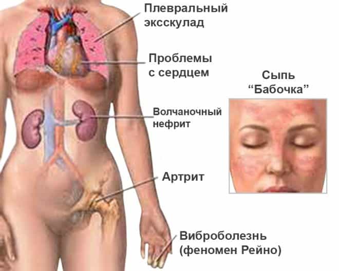 Красная волчанка системная (опорно двигательная система)