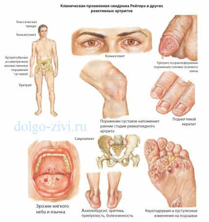 Артриты реактивные