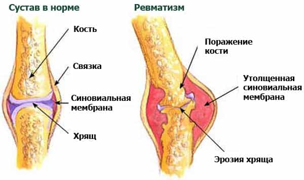 Причины ревматизма