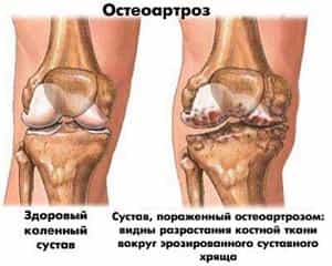 Остеоартроз коленного сустава