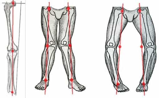 Остеоартроз деформирование костей ног