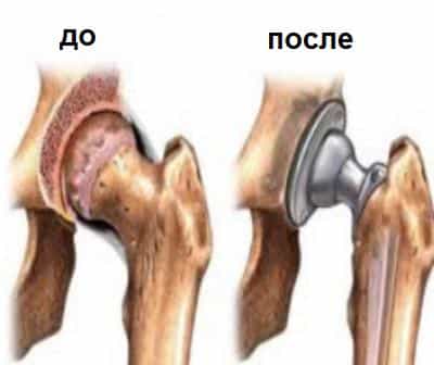 Протезирование плечевого сустава при артрозах