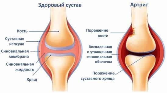 Ревматоидный артрит