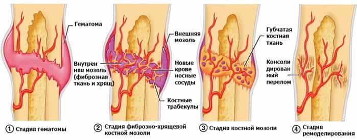 Костная мозоль