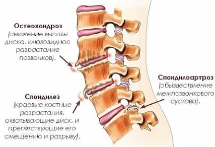 Остеохондроз