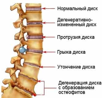 Стадии остеохондроза