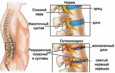 Остеохондроз