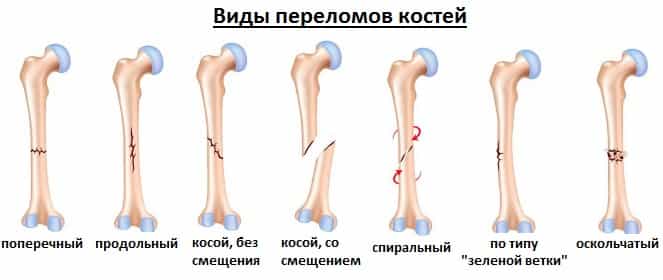 Виды переломов костей
