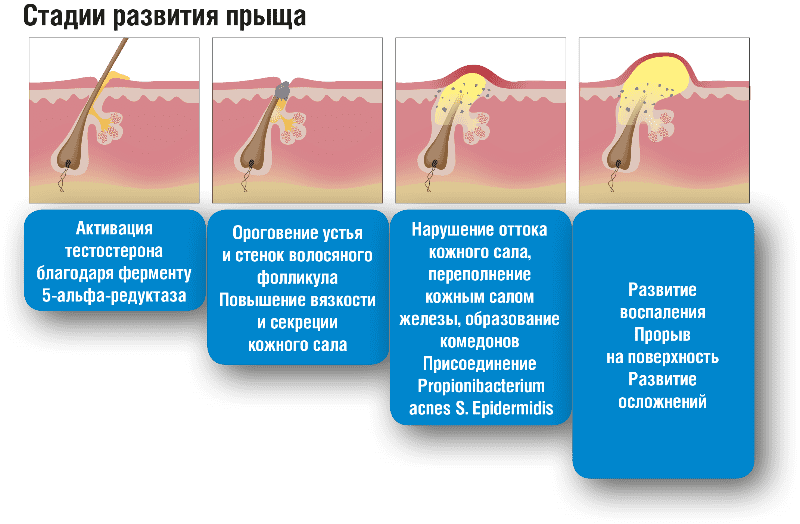 Что такое прыщ, стадии развития прыща