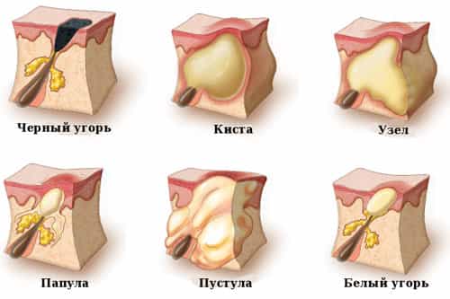 Чёрный угорь, киста, узел, папула, пустула, белый угорь