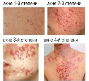 Четыре степени поражения кожи акне