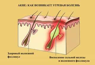 Как возникает угревая болезнь акне